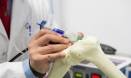 Designing customised implants
