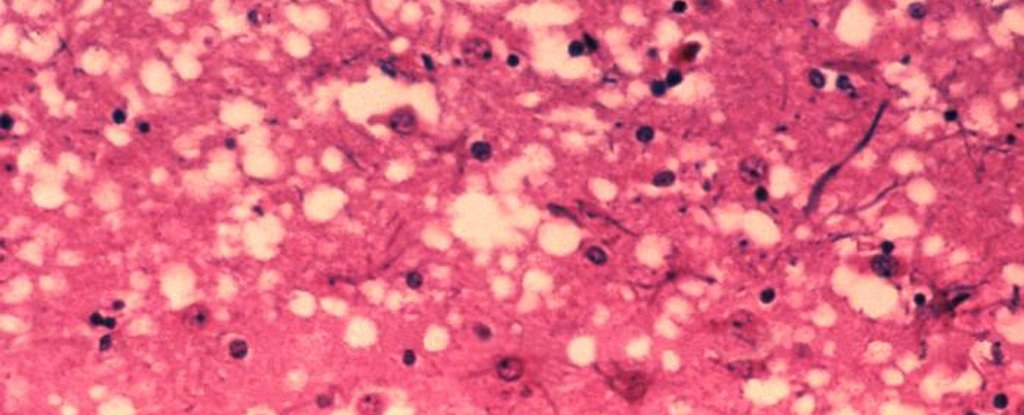 Microscopic holes in brain matter found in mad cow disease. 