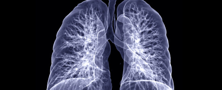 Still Short of Breath? Here Are 3 Ways COVID-19 Can Damage Lungs Long ...