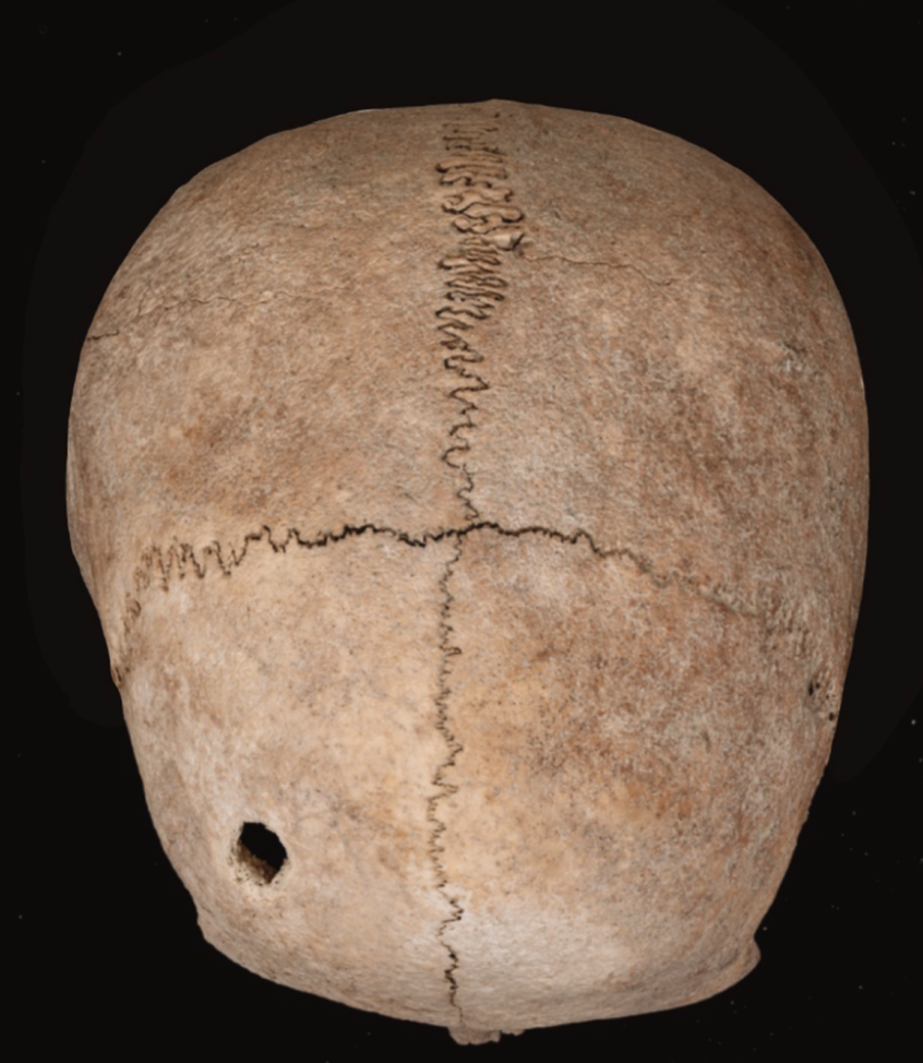 A Nail Hole in This Roman Skull May Have Been an Outdated Public Health ...