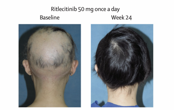 New Hair Loss Drug Approved Restores 80 Of Hair Loss In Some Alopecia   AlopeciaRecovery 600x379 