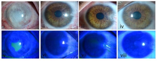 Groundbreaking Stem Cell Therapy Can Repair Vision After Eye Injury ...