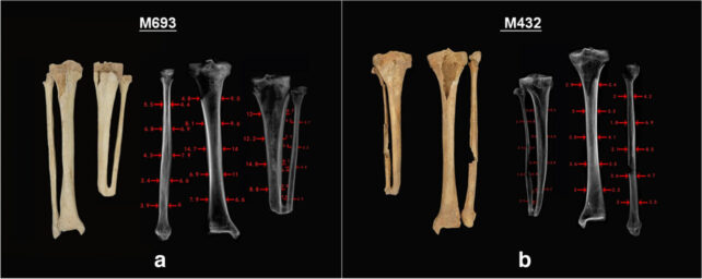 Panel of images showing two amputated and two intact lower leg bones, alongside X-ray images of the bones.