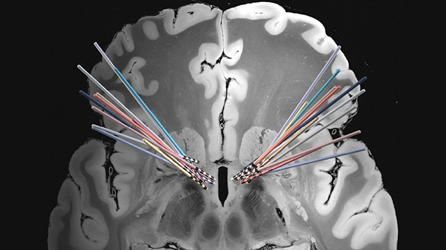 The Neural Signature of OCD Has Been Recognized in The Human Mind