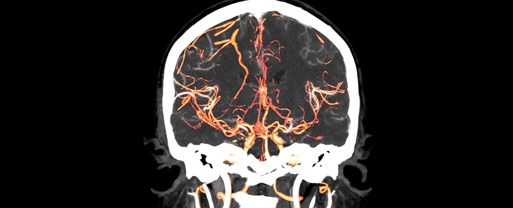 Brain scans