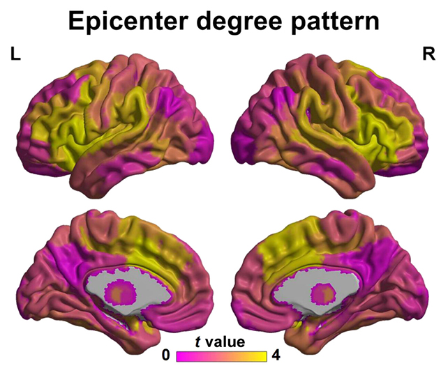 The Beginning Level of Schizophrenia Might Have Been Present in Mind Scans