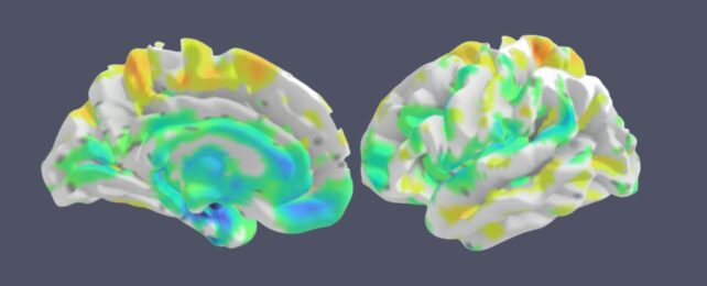 Scientists Name New Type of Memory Loss Often Mistaken For Alzheimer's