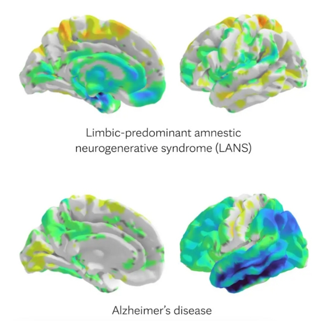 Sets of brain scans showing different colored regions