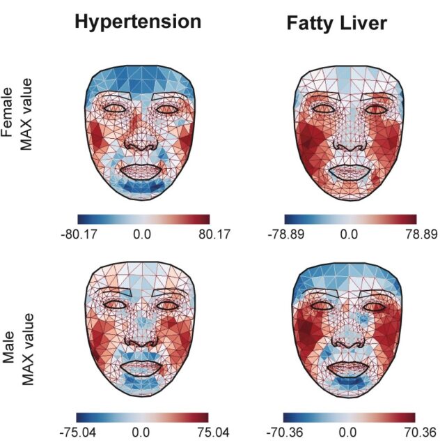 The difference in facial temperature distributions for males and females with hypertension and fatty liver disease. (Yu et al., Cell Metabolism, 2024)