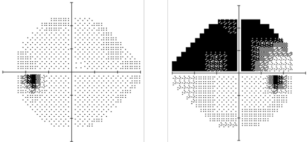 Visual Field Test