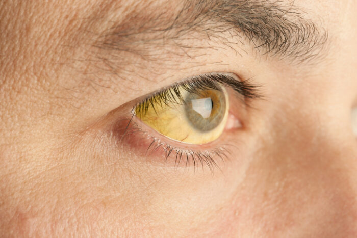 Close up of eye where whites are tainted yellow