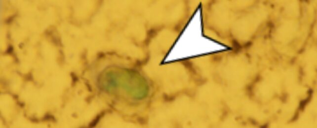 small object in a yellow part of brain, with a white arrow