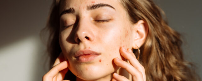 woman with acne, eyes closed in the sun