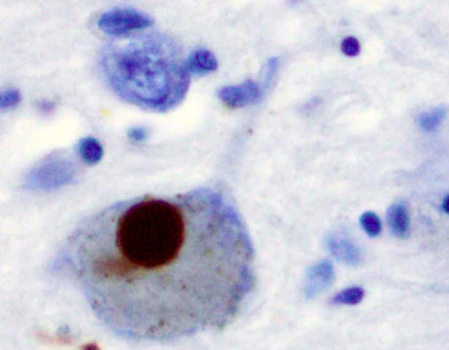 Alpha synucleinLewyBodyParkinsons642