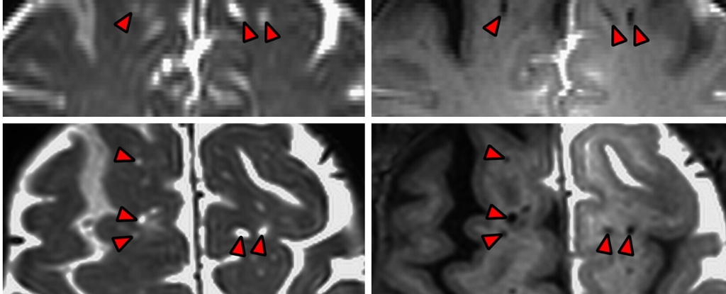 Scientists Mapped The Human Brain’s Sewage System For The First Time : ScienceAlert