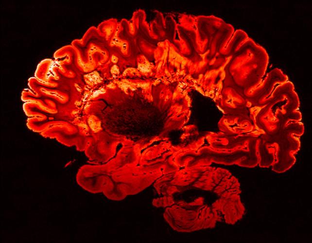 MRI scan of human brain