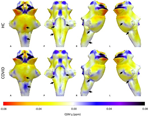 MRI Long COVID Brainstem