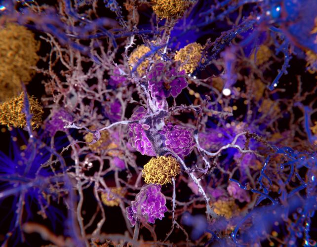 Clumps of yellow forming among purple neurons 