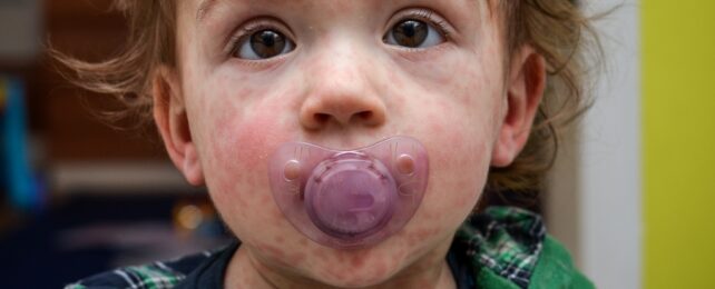 A close up of the face of a child with measles