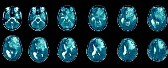 Magnetic resonance imaging scans of human head with glioblastoma. scans are shown in a 2 by 6 grid in blue on a black background.