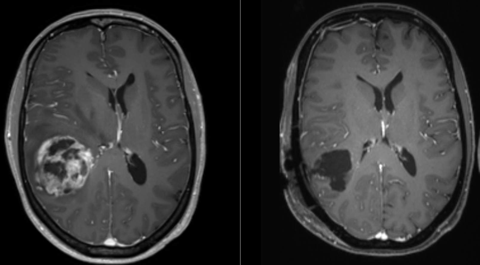 MRI Image of a Glioblastoma before and after surgery