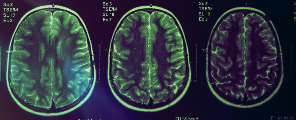 Alzheimer’s Brain Shrinkage May Signal Treatment Success