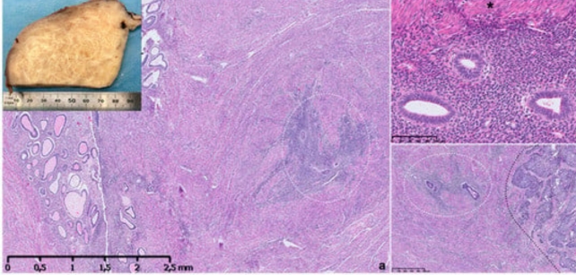 Macroscopic and microscopic appearance of adenomyosis