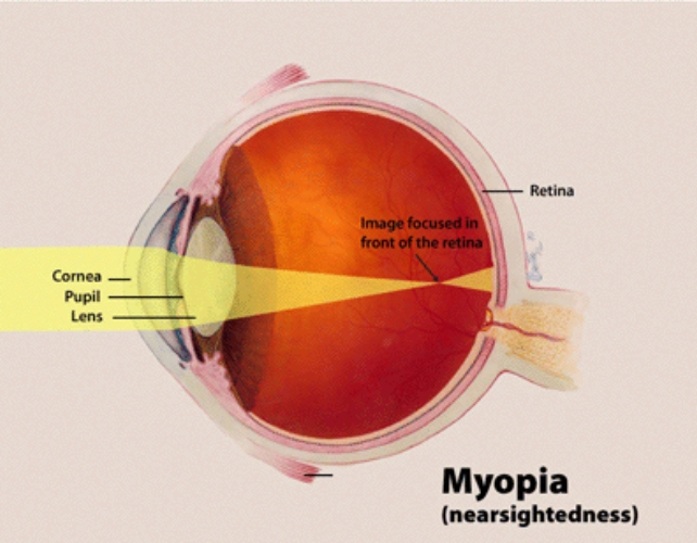 Myopia diagram