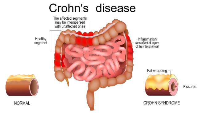 diagram of crohn's disease