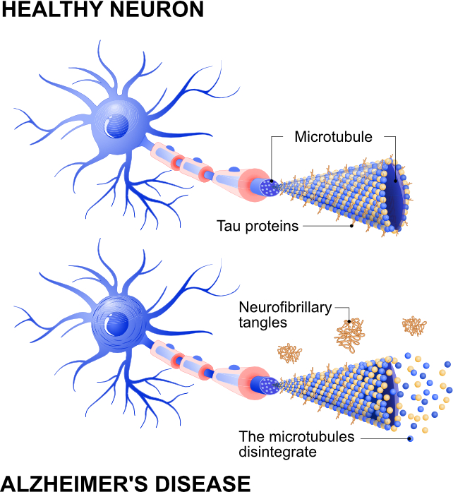 diagram of tau tangles in the brain