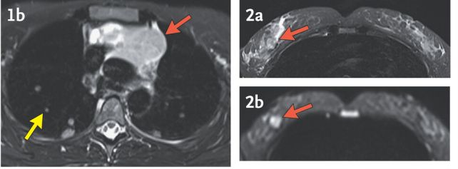 Prenatal DNA Screening Can Serendipitously Reveal Hidden Maternal Cancers