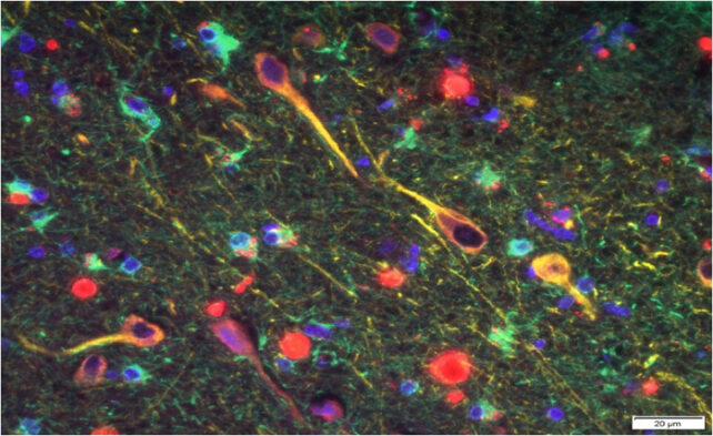 Microbes Mouth Dementia