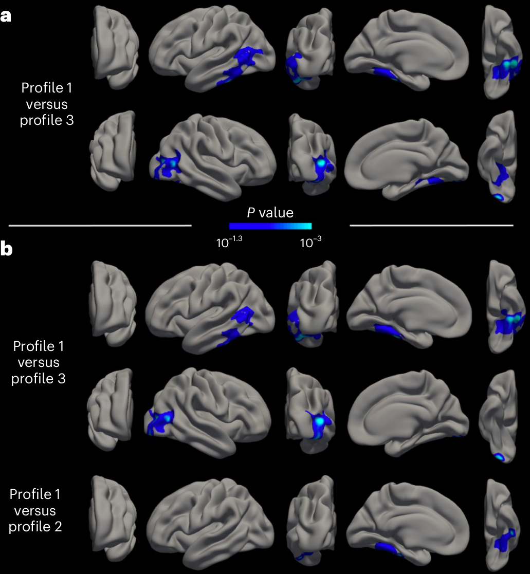 Series of brain scans with levels of atrophy in each comparison highlighted by blue to light blue