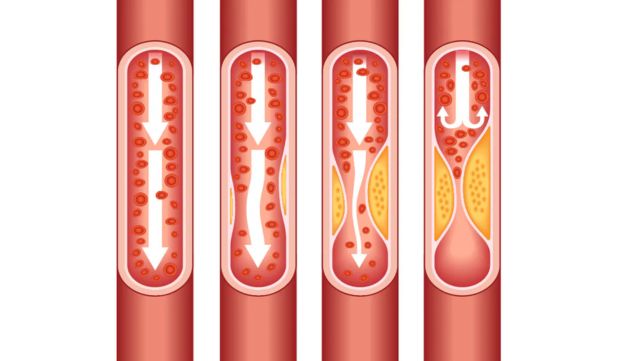 Diagram showing plaque formation in diseased arteries