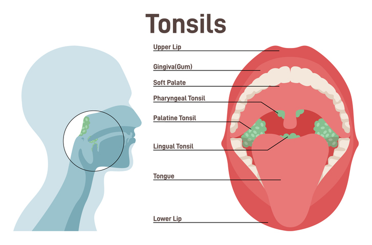 Diagram showing the position of tonsil lymphoid tissues in the back of the mouth