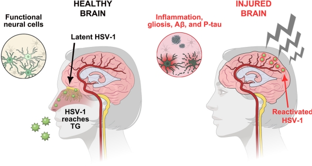 Mild Yet Chronic Brain Injuries May Reawaken The Herpes Simplex Virus