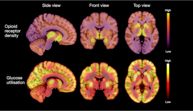 brain scans of anorexia nervosa patients