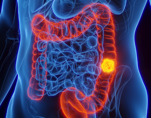 bowel cancer diagram