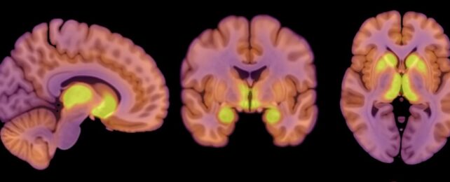 brain scans of anorexia nervosa patients