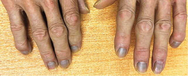 patient's silver toned fingers