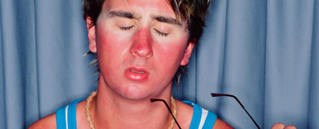 man with sunburned face