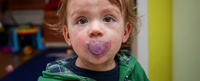 US Measles Outbreak Surges Towards 100 Cases