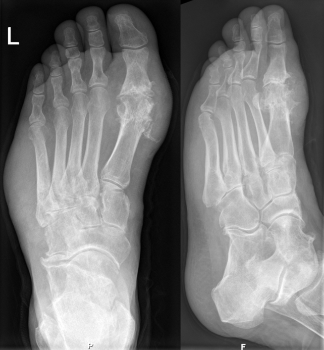 Huge Study Shows Where Gout Comes From, And It Isn't What We Thought