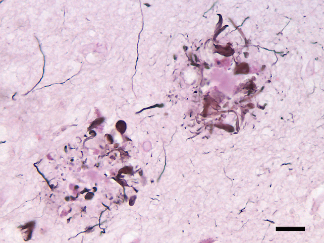 Two neuritic plaques, or extracellular deposits of beta amyloid protein, from the brain of a patient with Alzheimer's disease