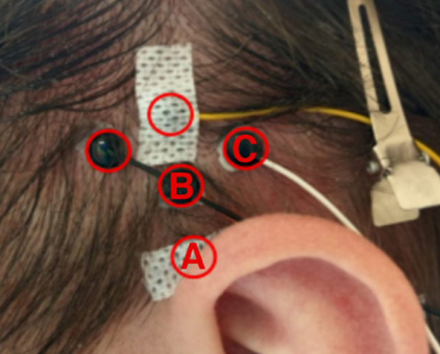 EMG electrodes on a person's head