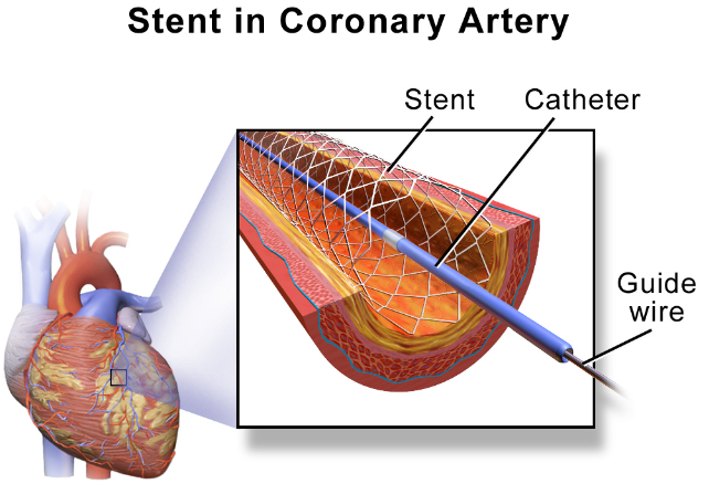 stent diagram