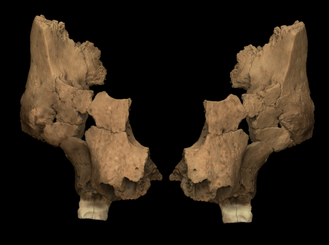 Facial Jaw Reconstruction