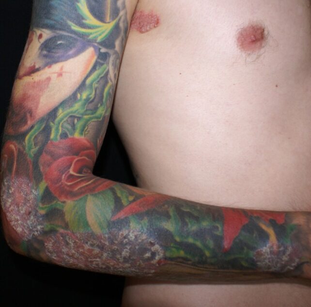 Twins Study Suggests Tattoos May Increase Your Risk of Skin Cancer