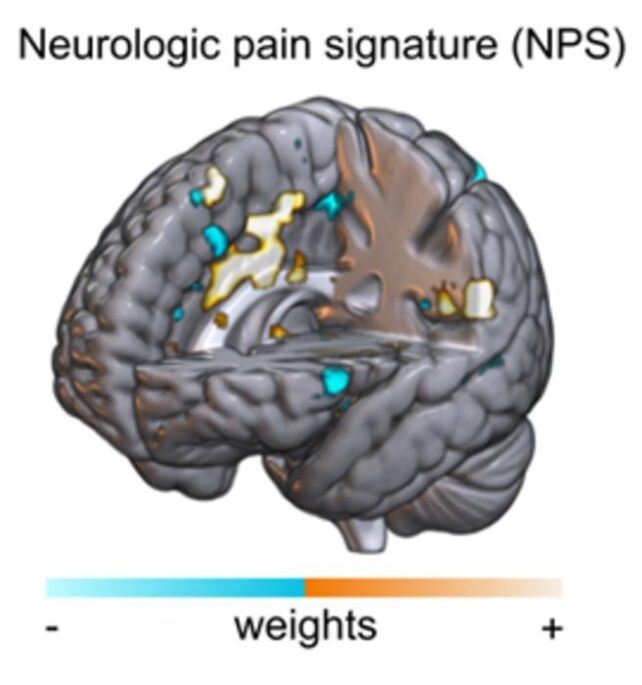 Neurologic pain signature