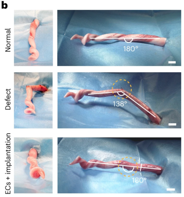 3D Printed Penis Implant